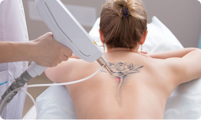 Tattoo Removal | Laser Tattoo Removal Treatment UK | Beagone